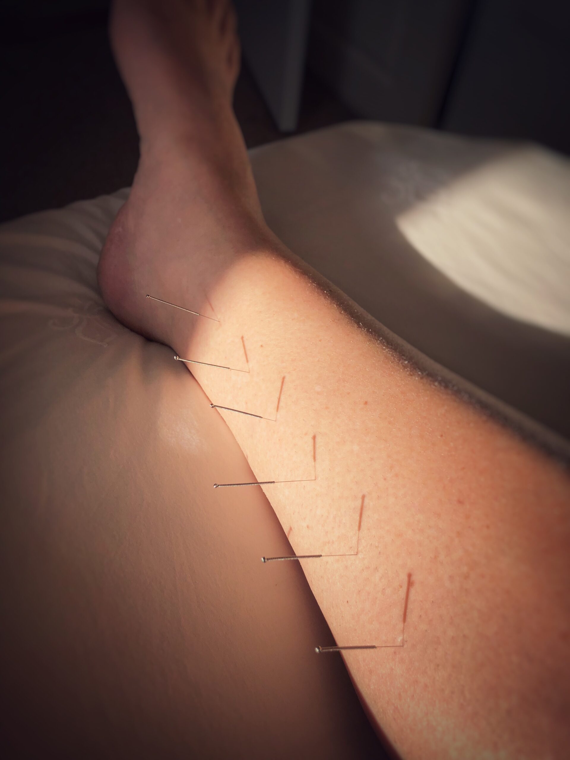 Dry Needling Treatment in Kuala Langat: Effective Pain Relief and Muscle Relaxation